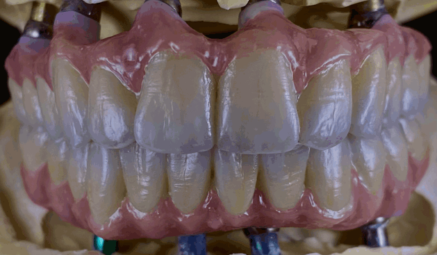 Protesi su impianti realizzata con tecnologia odontotecnica